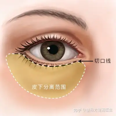手术or非手术哪个才是最适合你的面中部提升方式盘点睑缘切口小切口