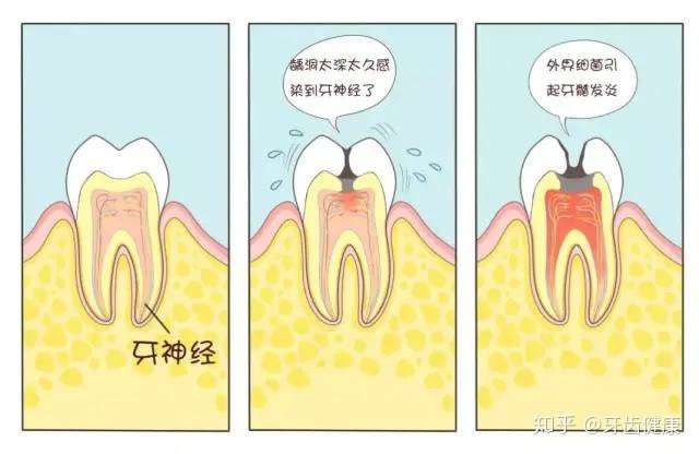 牙齿剧烈疼痛可能是牙髓炎需要及时治疗