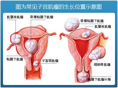 去他妈的子宫肌瘤 知乎