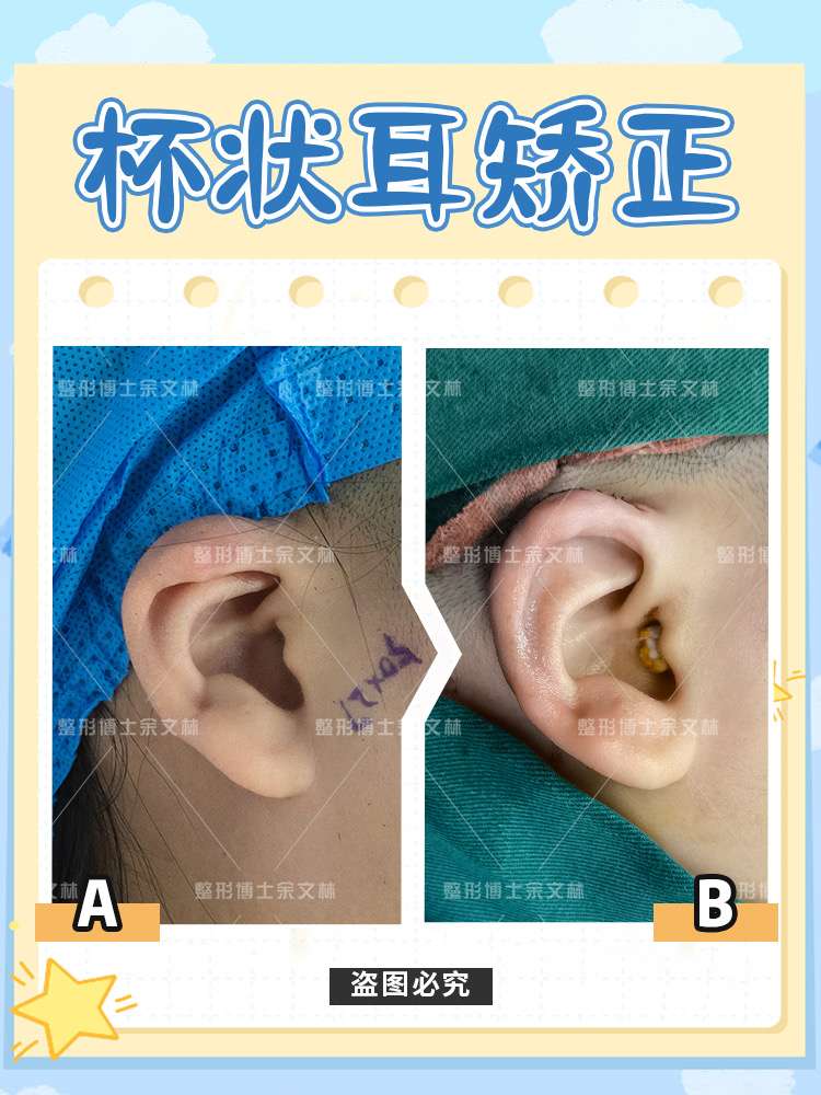 杯状耳案例杯状耳矫正成正常耳