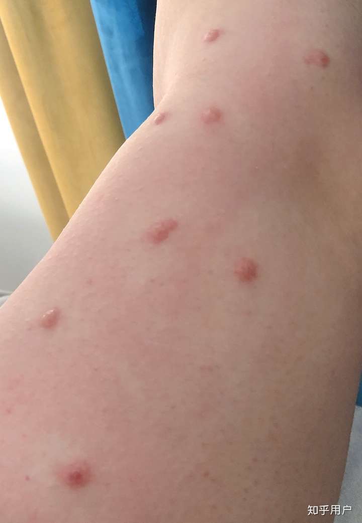 被蚊子咬的红包图片