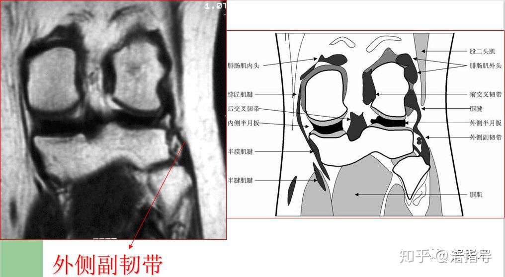 膝关节半月板损伤核磁诊断要点详解与治疗分析 知乎