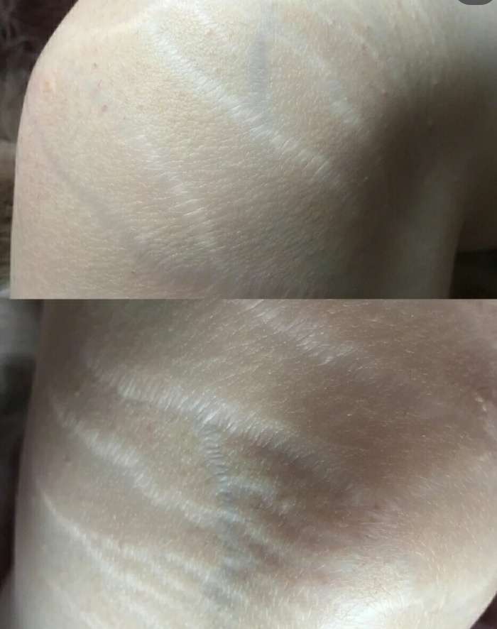 生长纹真的好痛苦脸蛋好可惜穿不了裙子