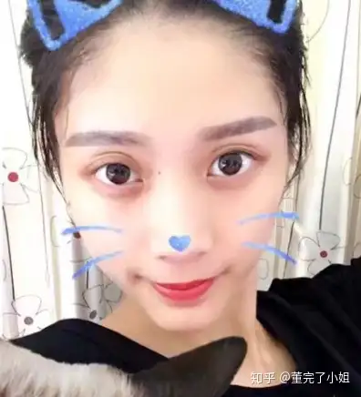 多眼皮双眼皮术后很宽很深双眼皮修复宽改窄