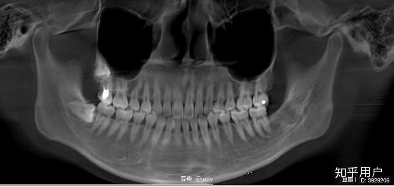 智齿长到上颌窦ct图图片