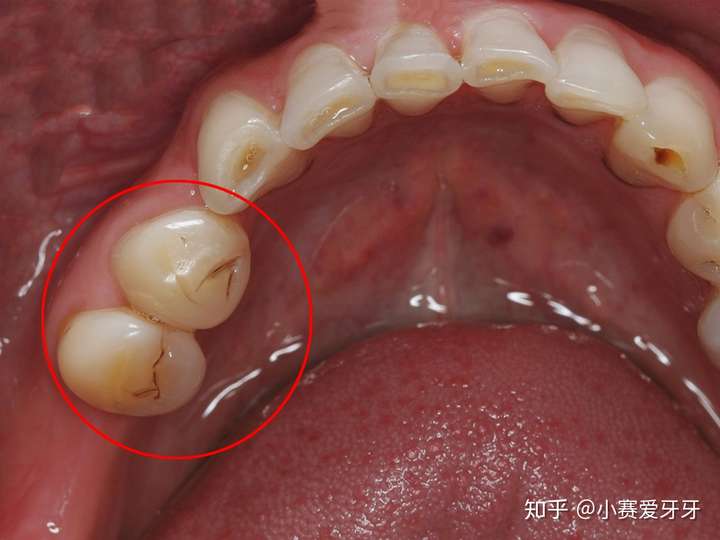 也有可能是是龋齿,也就是蛀牙,早期龋齿和色素有时候很难分辨,最好的