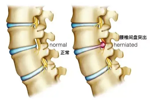 瑜伽治疗腰椎间盘突出的动作,哪些瑜伽式对腰椎好插图1 瑜伽治疗腰椎间盘突出的动作,哪些瑜伽式对腰椎好插图1