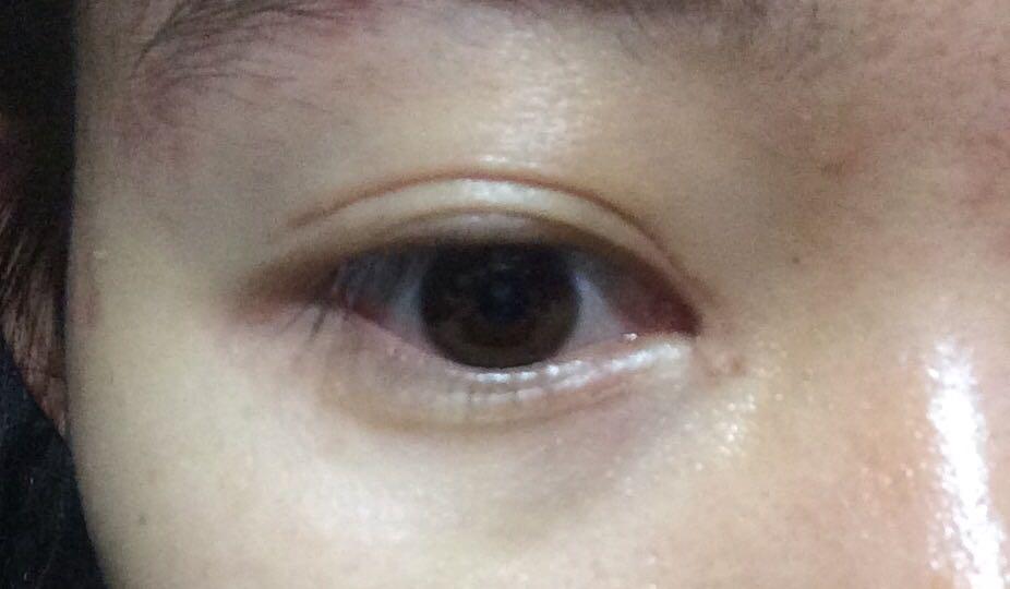 双眼皮手术后半年单侧三眼皮怎么办?