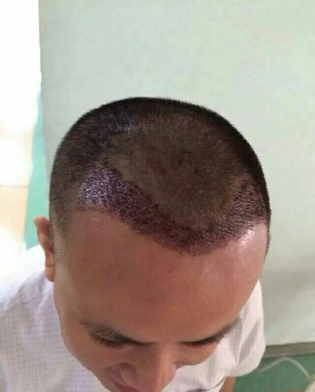 为什么秃顶的人这么多很少有做植发的?