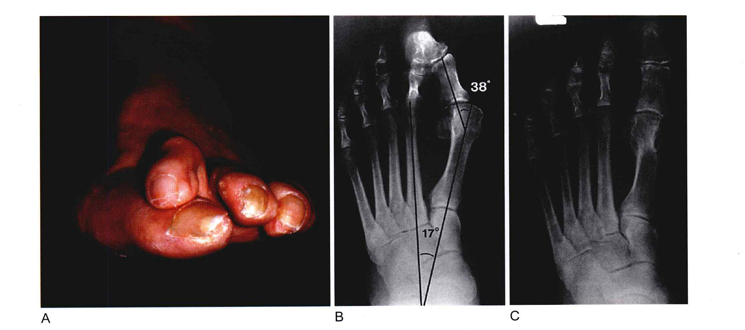 拇指外翻手术治疗有效吗,有什么副作用?会反复
