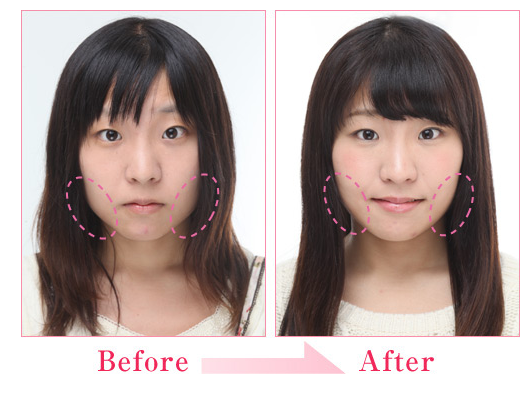 你所不知道的日本整容手术 日式审美与小颜术 知乎