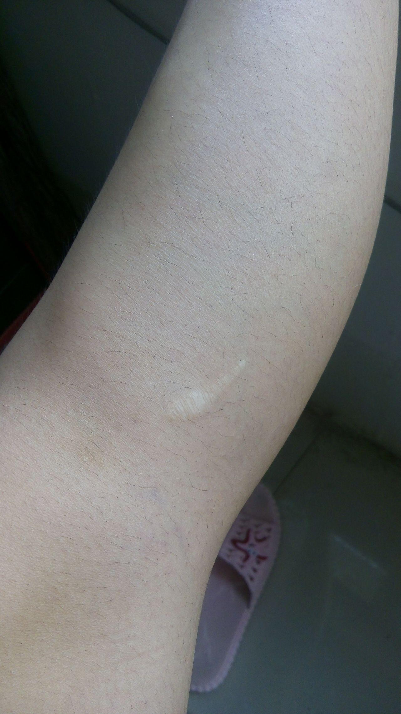 腿上有个小时候淘气留下的疤痕夏天穿短裙子短裤露出来大家会嘲笑我么