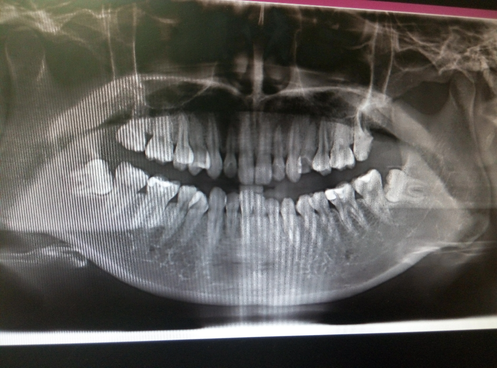 这颗牙做根管治疗还有救吗? - 牙科 - 知乎