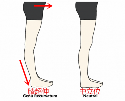如何科学矫正膝超伸