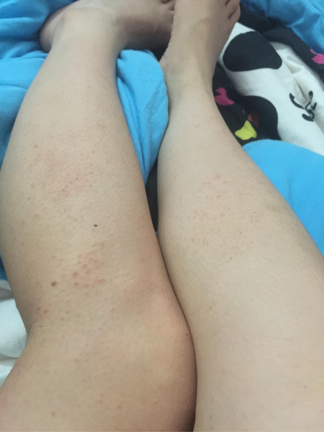 身体一整天起鸡皮疙瘩还痒(身体一整天起鸡皮疙瘩还痒用什么药)