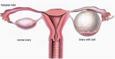 生理性卵巢囊肿有哪些症状?
