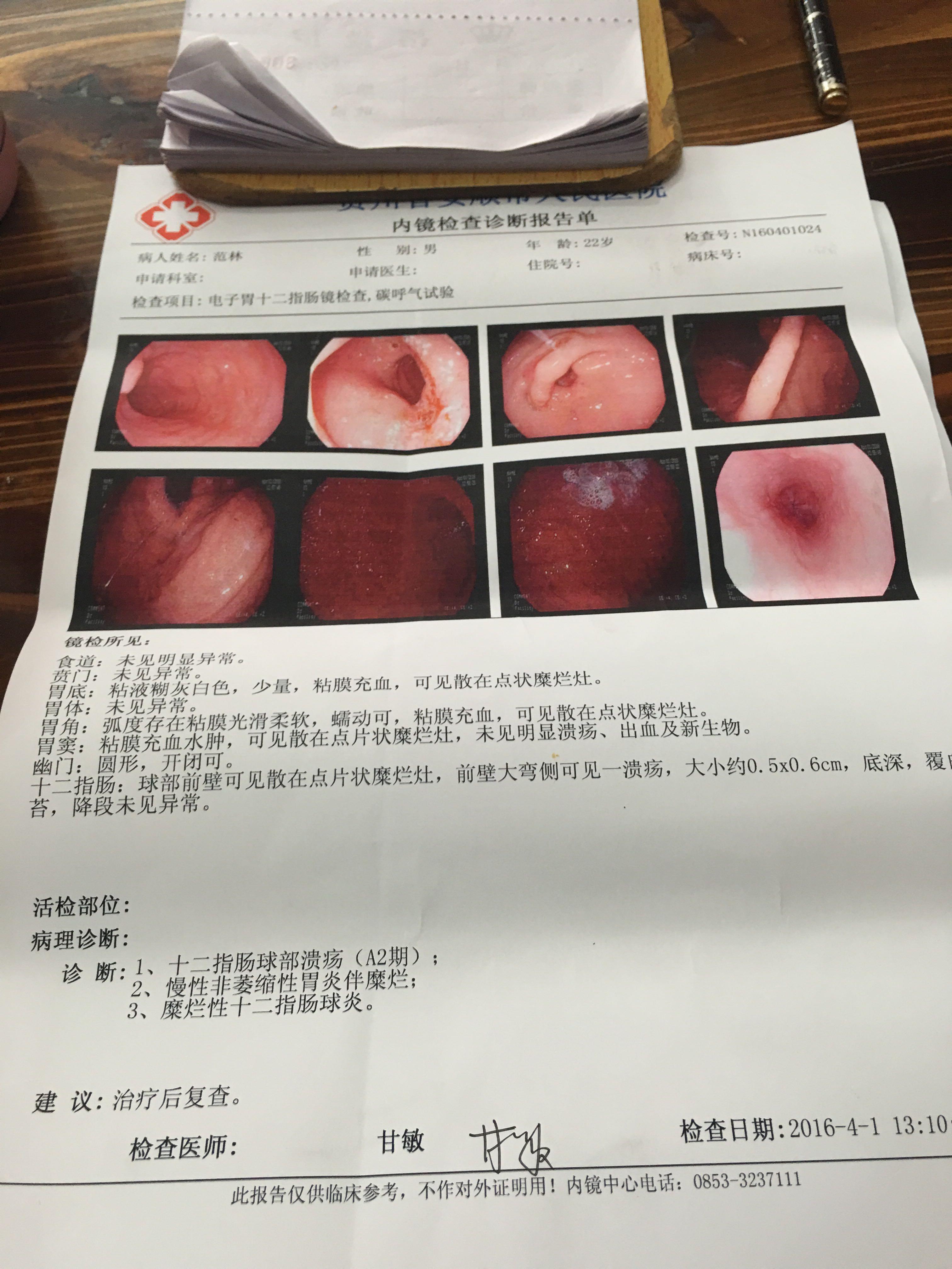 非萎缩性胃炎伴糜烂 十二指肠球部溃疡a2期.十二指肠球部糜烂!幽门螺