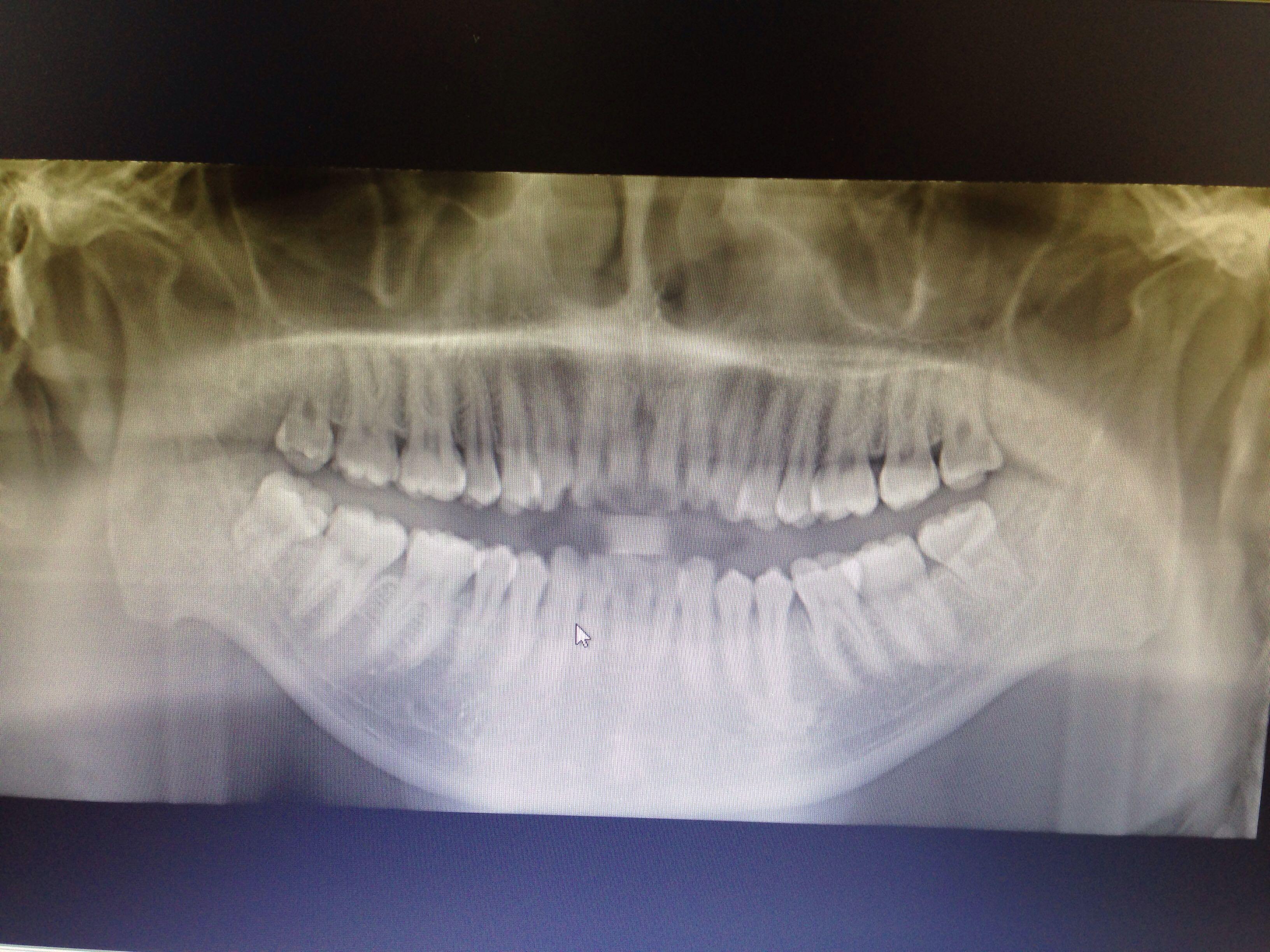 龅牙 嘴巴放松的时候嘴合不上,请问可以通过矫