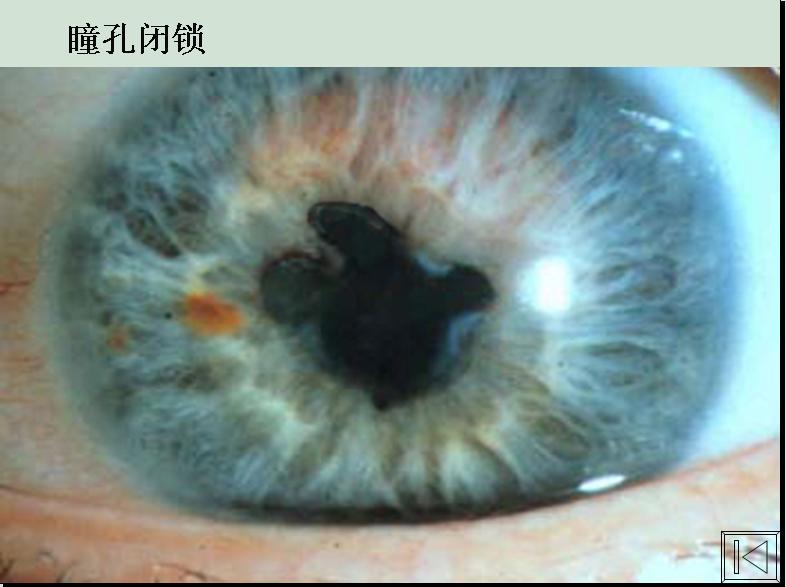 历史上的重瞳子是真实存在的吗？两个瞳仁在眼睛里是如何分布的？ - 知乎