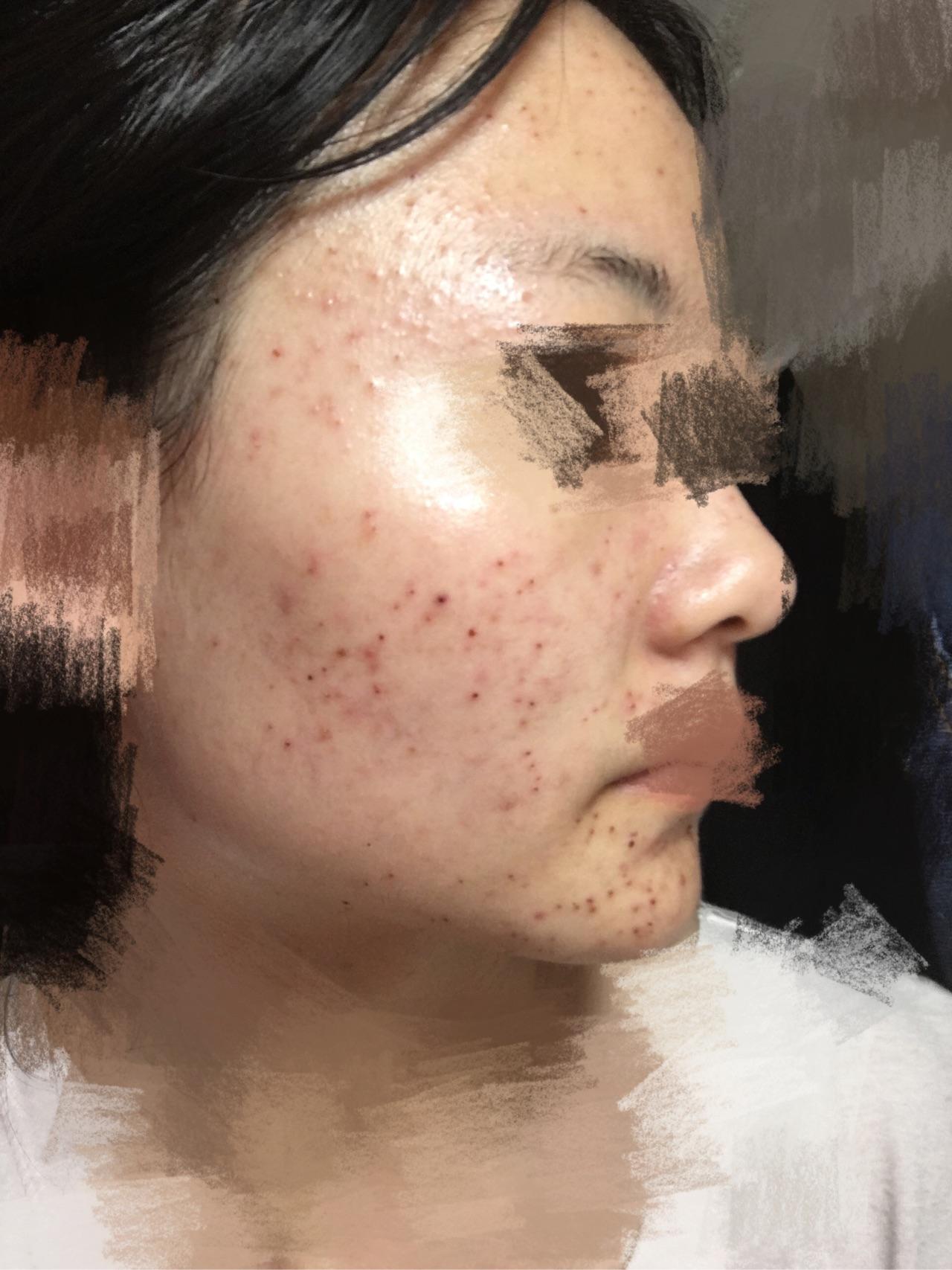 激光祛痘是否有副作用?价格大概多少?需要注