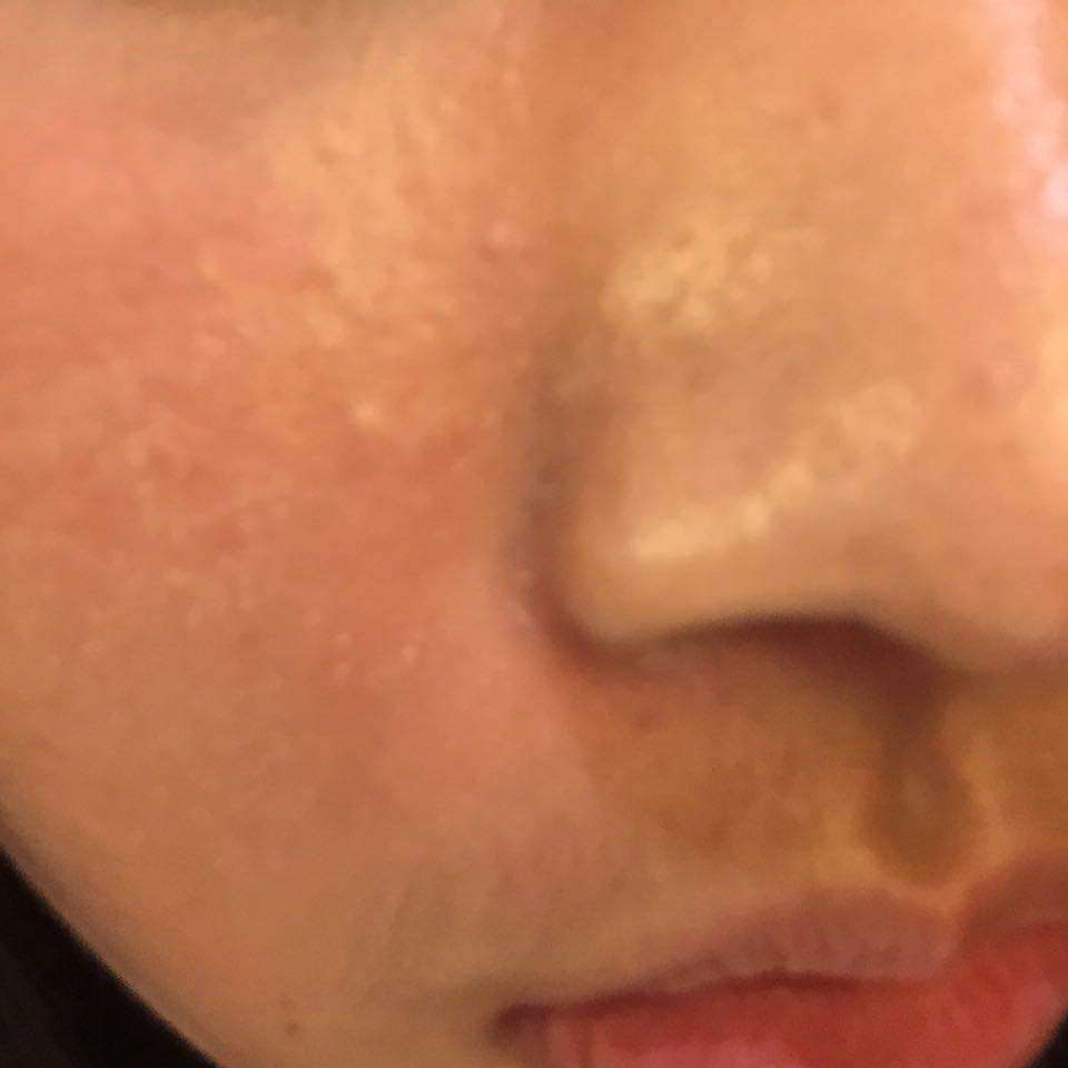 敏感肌…脸颊干各种脱皮额头闭口痒刺痛？ - 花吃了那兽的回答- 知乎