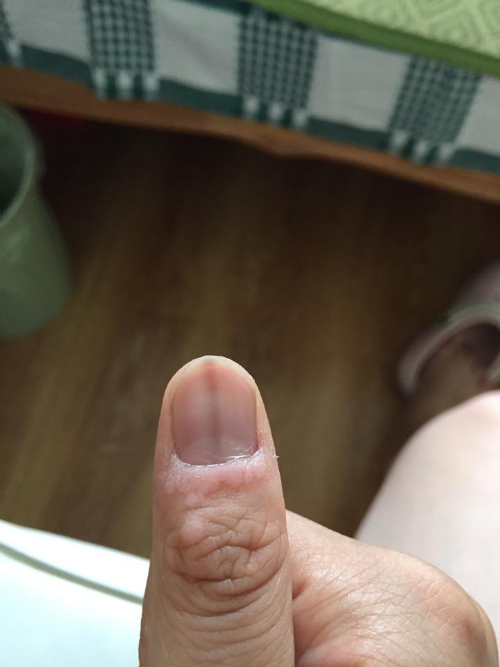 手指甲中间有一条深褐色纹路说明什么