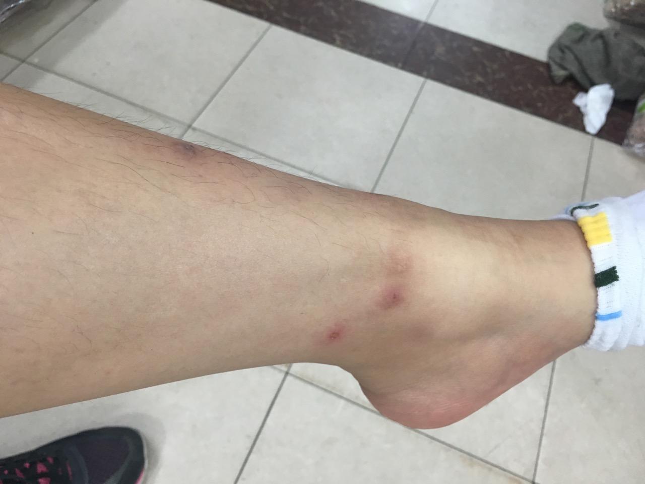 被跳蚤咬的全身都是包是什么样的感受! - 知乎