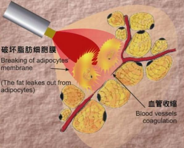 溶脂针和瘦脸针一样么?成分是什么有什么危害