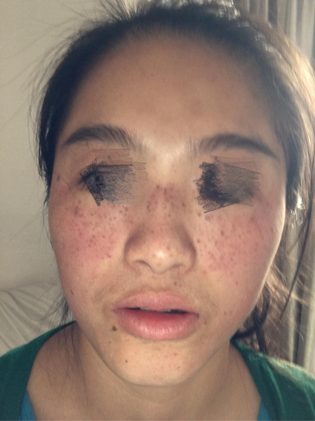 怎么去雀斑,激光祛斑怎么样? - FunQueen 的回