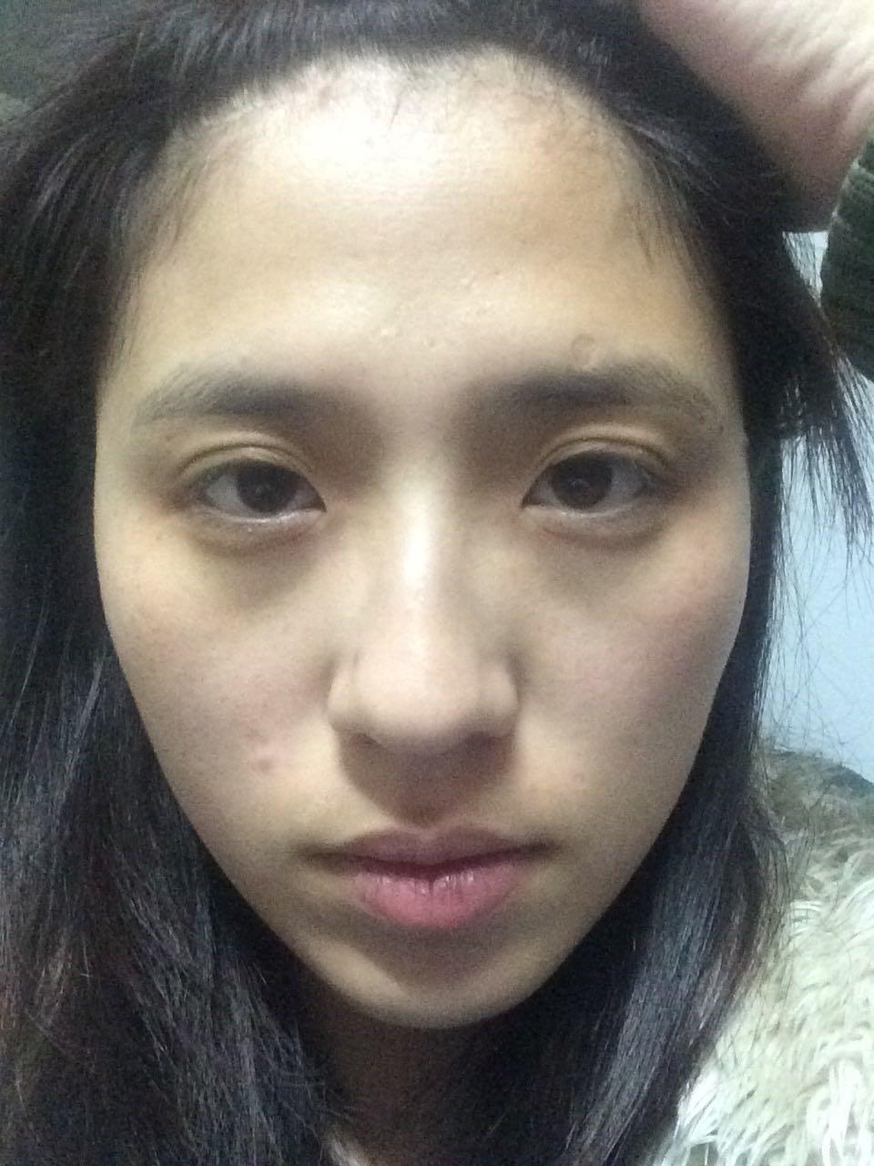 请问我这样的眼睛适合开眼角吗? - 美容整形 - 