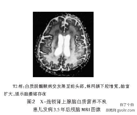 肾上腺脑白质营养不良adrenoleukodystrophyaldamn
