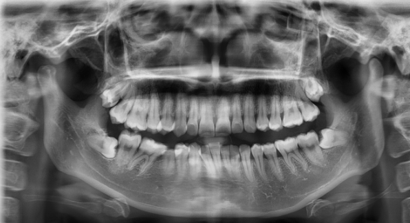 这样的四颗智齿好拔吗,费用高吗? - 口腔医学