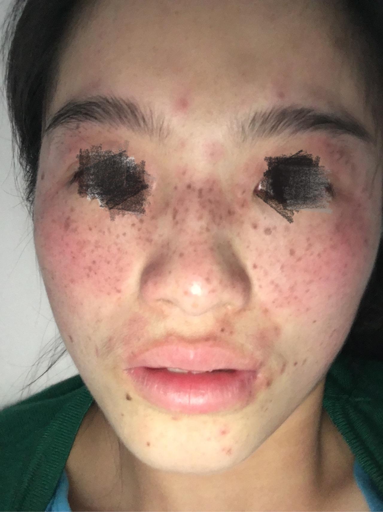 怎么去雀斑,激光祛斑怎么样?