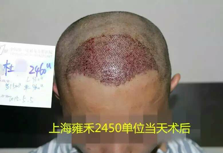 如何评价鲁尼的植发手术效果? - 上海雍禾白医