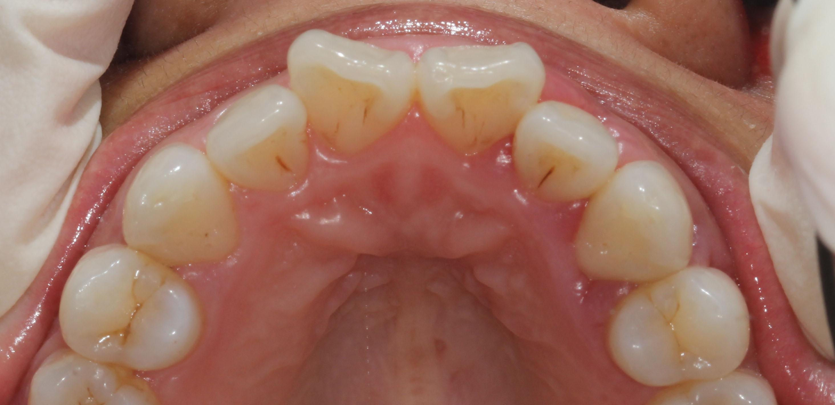 用激光进行牙龈矫正手术。医学上精确的牙齿3D插图照片摄影图片_ID:415547200-Veer图库