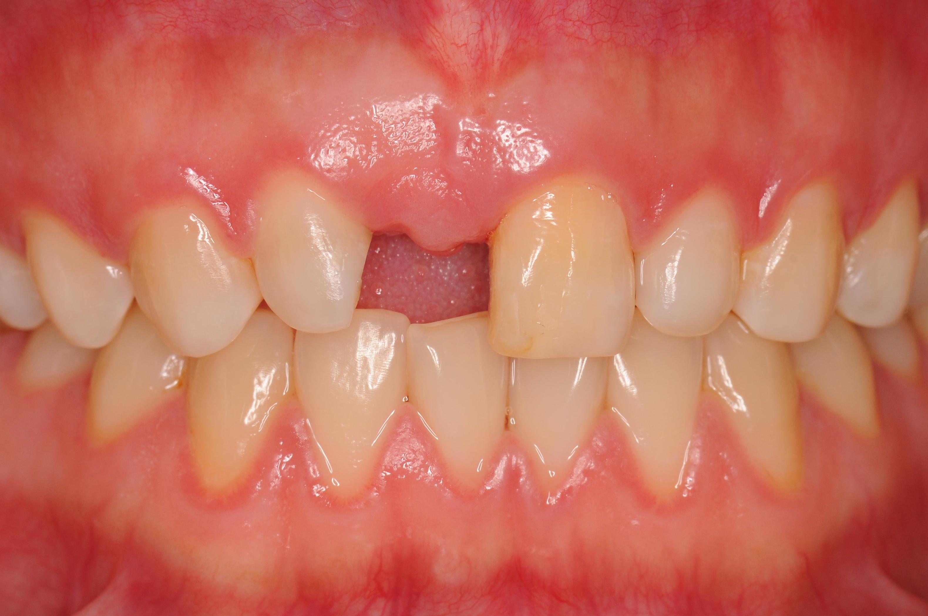 活动隐形义齿门牙遮丑树脂假牙套牙仿真临时假牙吃饭缺牙补牙神器-淘宝网
