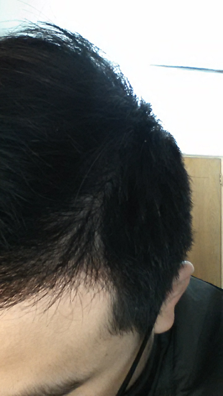 我这种额角头发变稀少的情况属于脱发吗? - 郭