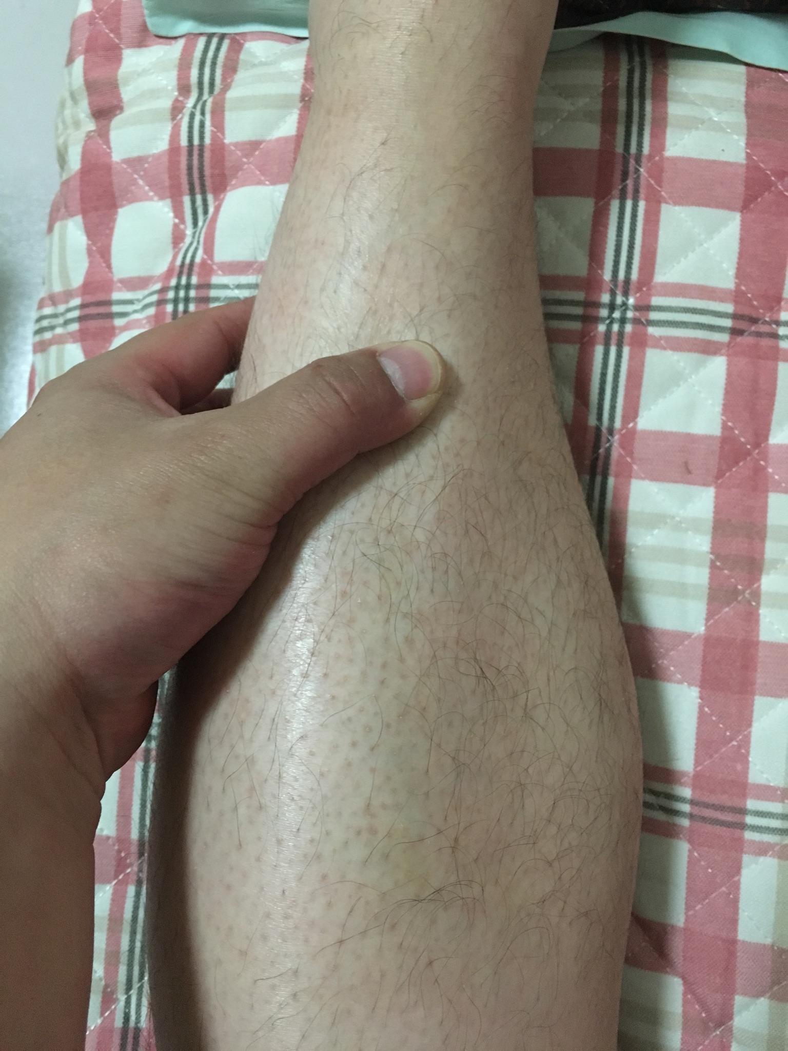 跑步小腿中下段特别疼 跑的时候每次落地都针