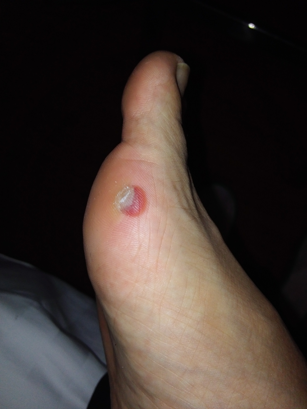 跑步脚趾起血泡怎么办阿?感觉脚要烂了?