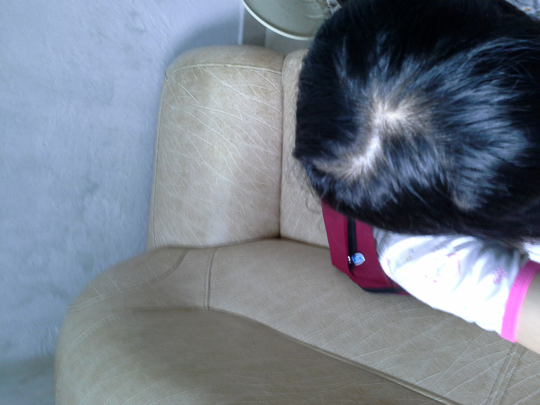 为什么我的头发会这样,是秃顶吗?