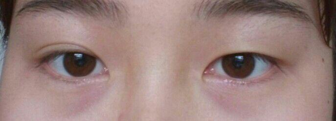 韩式切开、微创到底是全切吗? - 双眼皮 - 知乎