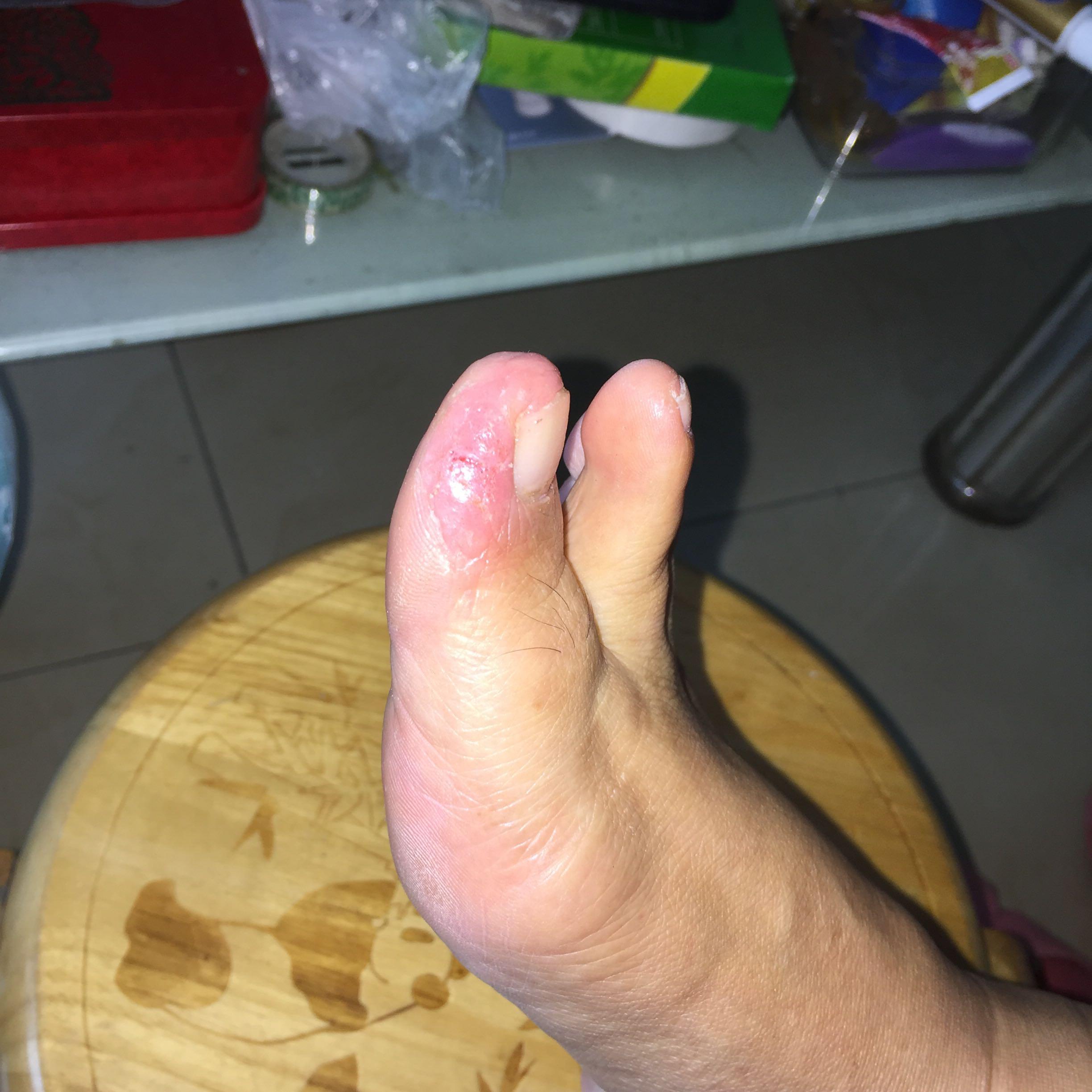 请问这是糜烂型足癣吗? 图片发不来 就放在回答里面了 ? - 知乎