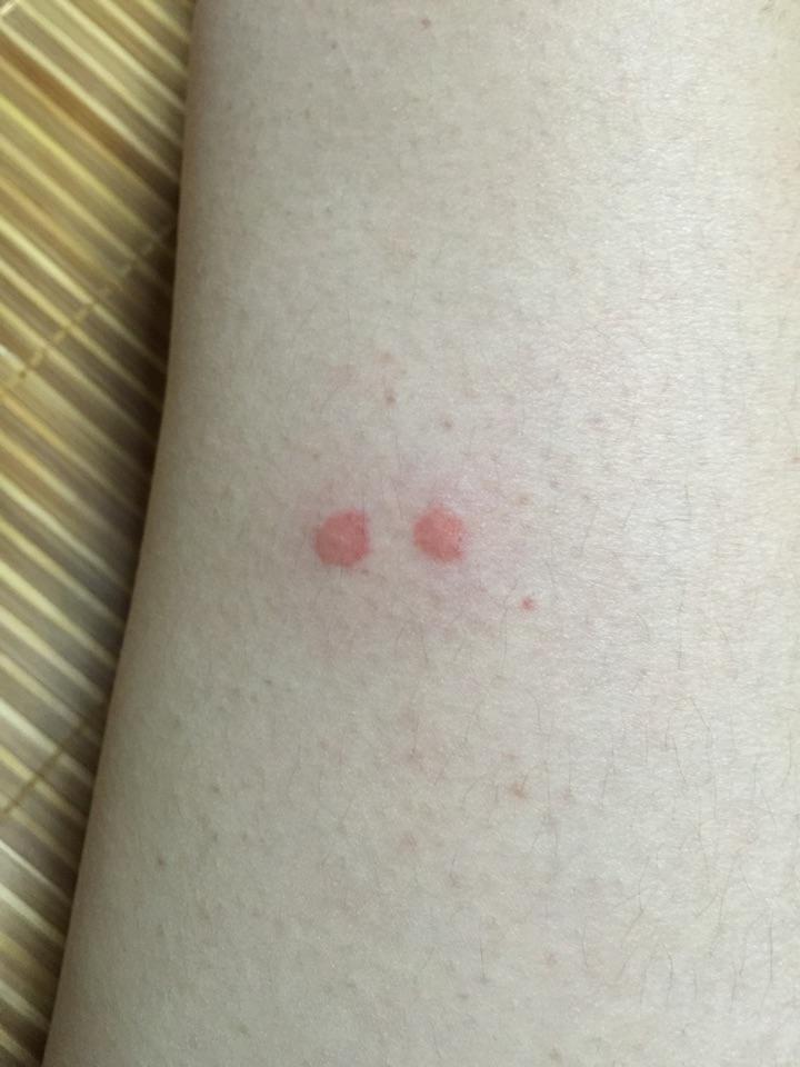 这是被什么虫子咬了?碰到就感觉痒,好几天了,