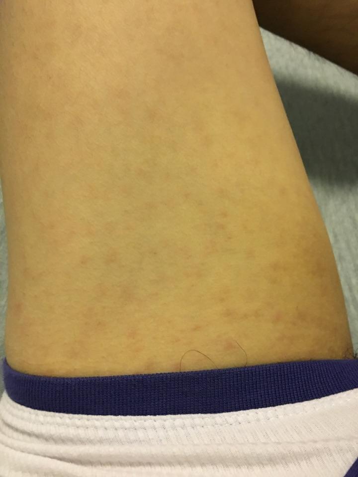 大腿内侧很多小红疹 不痛不痒是什么症状 有人
