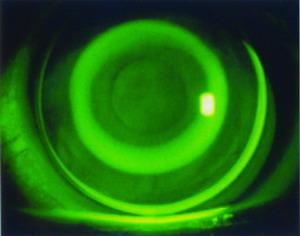 戴隐形眼镜对眼睛有什么危害吗?