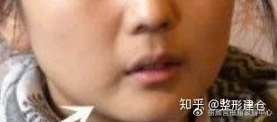面部吸脂之嘴角嘟嘟肉吸脂细说 知乎