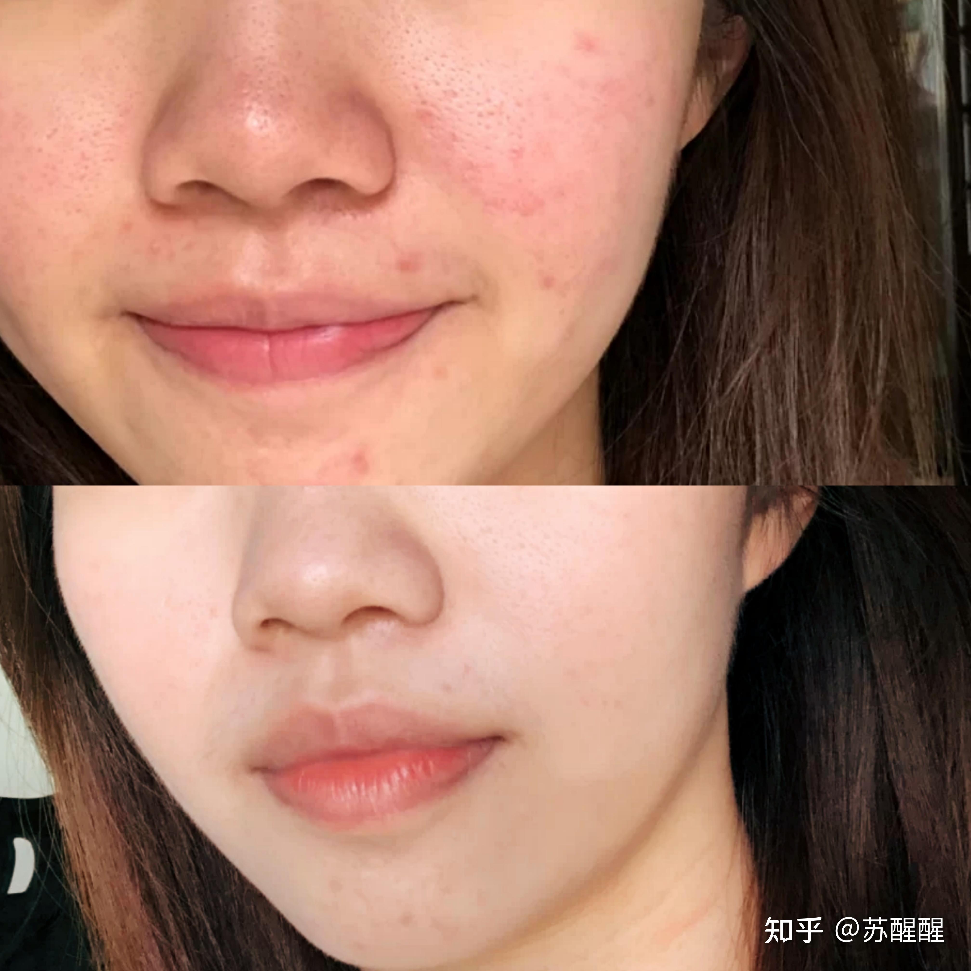 祛痘产品推荐——从皮肤问题到美丽解决之道
