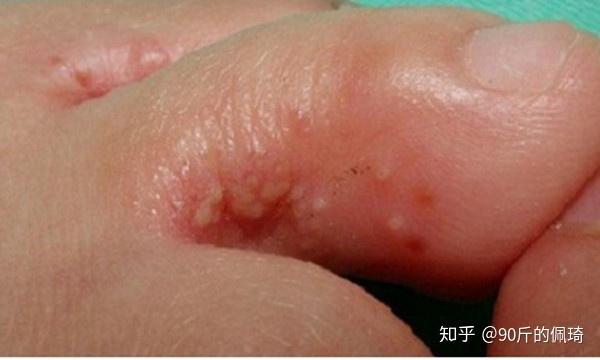 闢謠水皰性腳氣能把水泡擠爛嗎