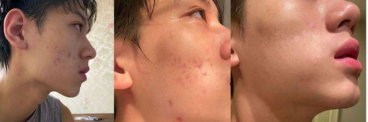 解决影响颜值最大的痘痘