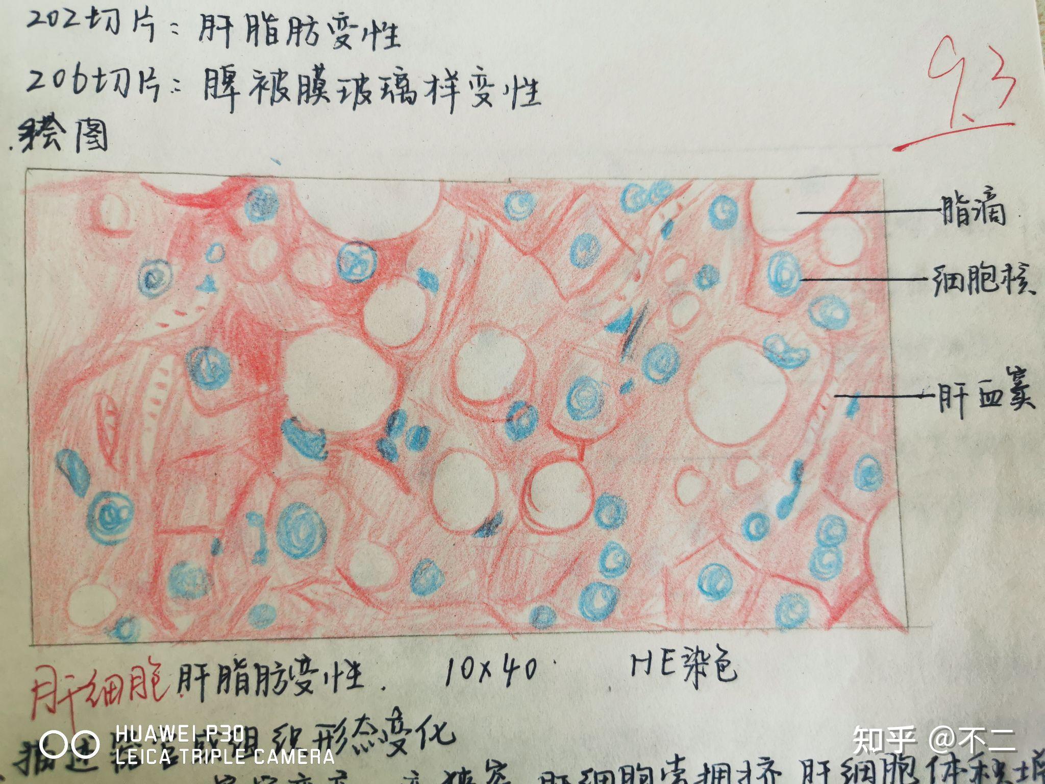 2肝细胞脂肪变性1肉芽组织持续更新病理红蓝铅笔手绘图来啦!